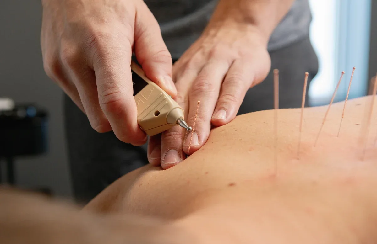 Close-up of acupuncture treatment at iON