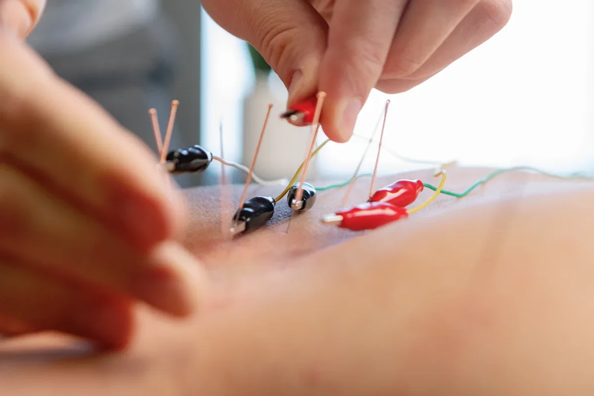 Close-up of electro-acupuncture treatment at iON